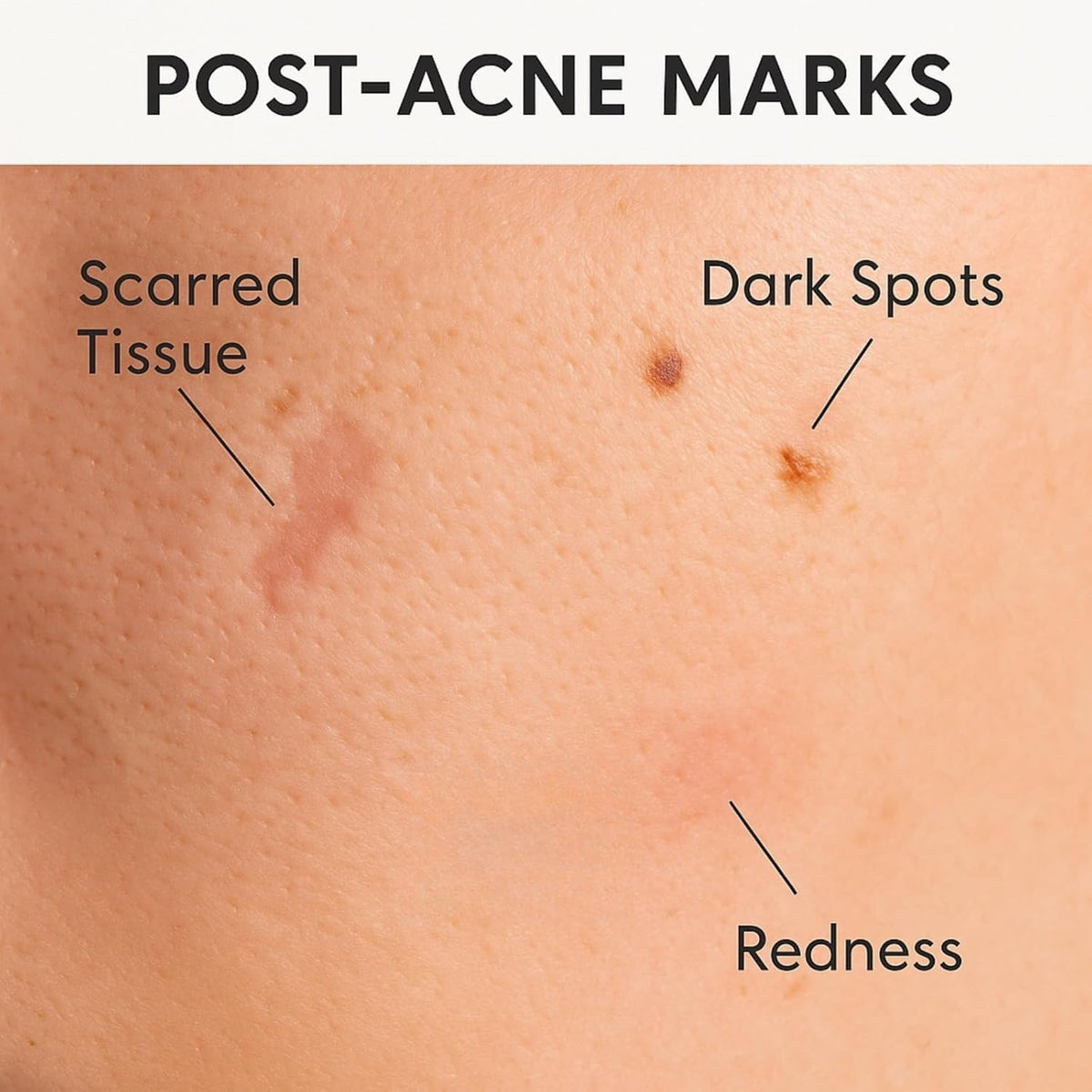 Acne Scar & Dark Spot Patches – Gentle Non-Adhesive Silicone Dots, Safe for Sensitive Skin – Ultra-Thin, Breathable & Nearly Invisible – 72 Pimple Patches, 2 Sizes